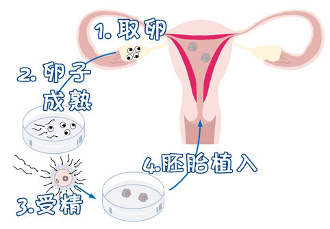 男性不妊